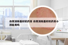 白斑消除最好的药膏 白斑消除最好的药膏小孩能用吗