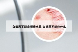 白癞风不能吃哪些水果 白癞风不能吃什么