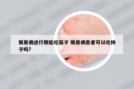 银屑病进行期能吃茄子 银屑病患者可以吃柿子吗?