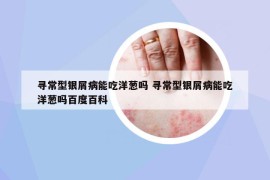 寻常型银屑病能吃洋葱吗 寻常型银屑病能吃洋葱吗百度百科