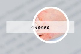 牛皮癣怕晒吗