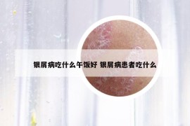 银屑病吃什么午饭好 银屑病患者吃什么