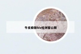 牛皮癣做hiv检测窗口期