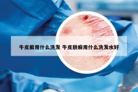牛皮廨用什么洗发 牛皮肤癣用什么洗发水好