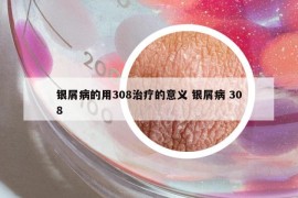 银屑病的用308治疗的意义 银屑病 308