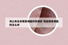 海口有名的银屑病医院有哪些 海南银屑病医院怎么样