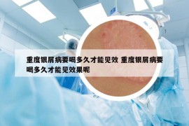 重度银屑病要喝多久才能见效 重度银屑病要喝多久才能见效果呢