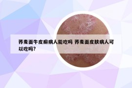 荞麦面牛皮癣病人能吃吗 荞麦面皮肤病人可以吃吗?