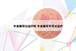 牛皮癣可以治疗吗 牛皮癣可不可以治疗
