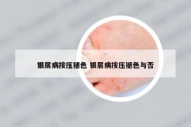 银屑病按压褪色 银屑病按压褪色与否