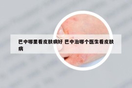 巴中哪里看皮肤病好 巴中治哪个医生看皮肤病