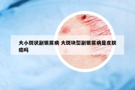 大小斑状副银屑病 大斑块型副银屑病是皮肤癌吗