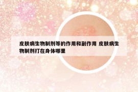 皮肤病生物制剂等的作用和副作用 皮肤病生物制剂打在身体哪里