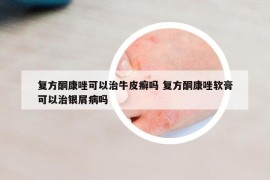 复方酮康唑可以治牛皮癣吗 复方酮康唑软膏可以治银屑病吗