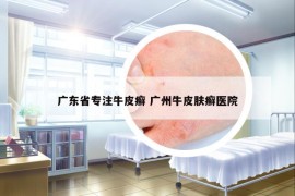 广东省专注牛皮癣 广州牛皮肤癣医院