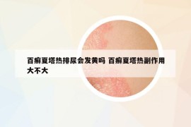 百癣夏塔热排尿会发黄吗 百癣夏塔热副作用大不大