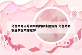 乌鲁木齐治疗银屑病的那家医院好 乌鲁木齐银屑病医院哪家好