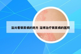 淄川看银屑病的地方 淄博治疗银屑病的医院
