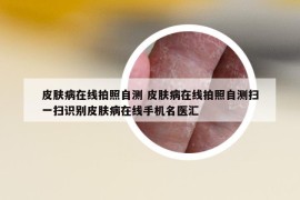 皮肤病在线拍照自测 皮肤病在线拍照自测扫一扫识别皮肤病在线手机名医汇