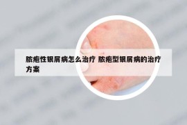 脓疱性银屑病怎么治疗 脓疱型银屑病的治疗方案