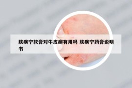 肤疾宁软膏对牛皮癣有用吗 肤疾宁药膏说明书