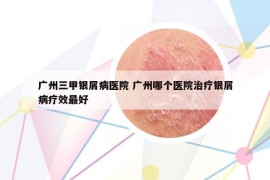 广州三甲银屑病医院 广州哪个医院治疗银屑病疗效最好