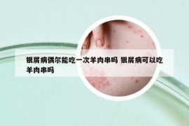 银屑病偶尔能吃一次羊肉串吗 银屑病可以吃羊肉串吗