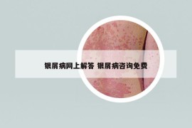 银屑病网上解答 银屑病咨询免费