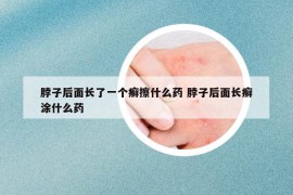 脖子后面长了一个癣擦什么药 脖子后面长癣涂什么药