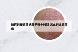 如何判断银屑病属于哪个时期 怎么判定银屑病