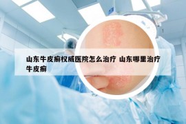 山东牛皮癣权威医院怎么治疗 山东哪里治疗牛皮癣