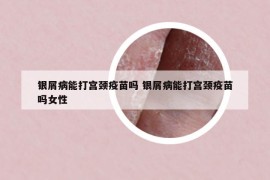 银屑病能打宫颈疫苗吗 银屑病能打宫颈疫苗吗女性