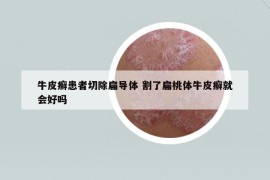 牛皮癣患者切除扁导体 割了扁桃体牛皮癣就会好吗