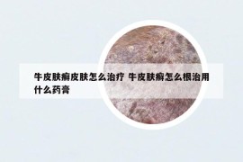 牛皮肤癣皮肤怎么治疗 牛皮肤癣怎么根治用什么药膏
