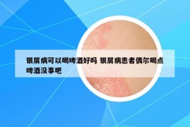银屑病可以喝啤酒好吗 银屑病患者偶尔喝点啤酒没事吧