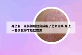 身上有一点伤然后就变成癣了怎么回事 身上一有伤就好了后就变黑