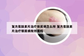 复方氨肽素片治疗银屑病怎么样 复方氨肽素片治疗银屑病有效果吗