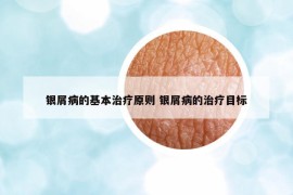银屑病的基本治疗原则 银屑病的治疗目标