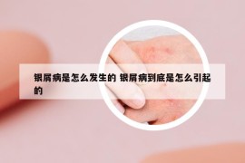 银屑病是怎么发生的 银屑病到底是怎么引起的