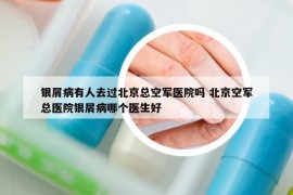 银屑病有人去过北京总空军医院吗 北京空军总医院银屑病哪个医生好