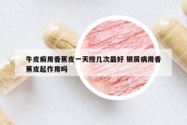牛皮癣用香蕉皮一天擦几次最好 银屑病用香蕉皮起作用吗