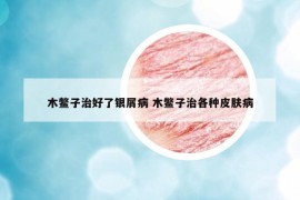 木鳖子治好了银屑病 木鳖子治各种皮肤病