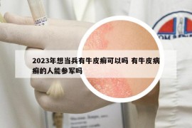2023年想当兵有牛皮癣可以吗 有牛皮病癣的人能参军吗