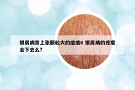 银屑病背上张颗粒大的痘痘6 银屑病的疙瘩会下去么?