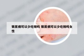 银屑病可以少吃辣吗 银屑病可以少吃辣吗女性