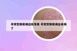 寻常型银屑病边际发黑 寻常型银屑病全身满了