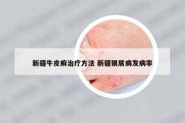 新疆牛皮癣治疗方法 新疆银屑病发病率