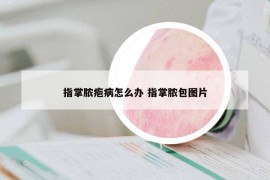 指掌脓疱病怎么办 指掌脓包图片