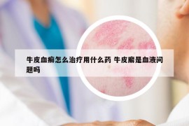 牛皮血癣怎么治疗用什么药 牛皮廨是血液问题吗