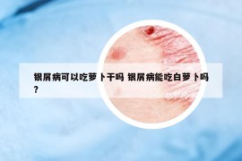 银屑病可以吃萝卜干吗 银屑病能吃白萝卜吗?